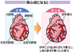 狭心症になると