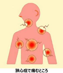 狭心症で痛むところ