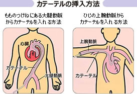 カテーテルの挿入方法