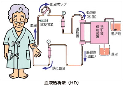 血液透析法（HD）